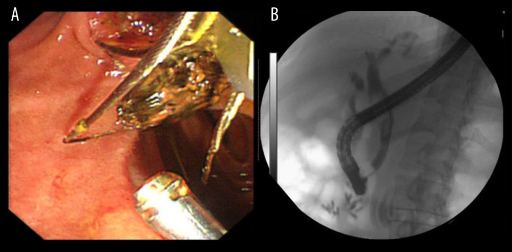 (A) ERCP was performed and a stone removal basket was used to remove some small stones; (B) Intraoperative cholangiography during ERCP.