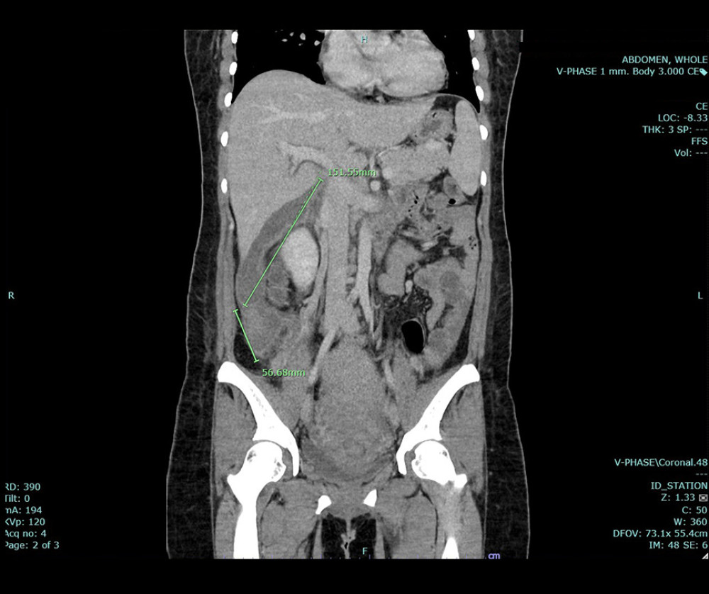 Previous computed tomography scan of the patient’s entire abdominal region (coronal view). Identification of fluid accumulation with concomitant air bubble formation from the lower uterine segment, raising concerns about potential uterine dehiscence at her prior cesarean section scar site. Remarkable abscess formation, characterized by dimensions of 6.5×1.4×3.6 cm and 2.1×3.4×2.3 cm, noted in the subhepatic region and the right paracolic gutter, measuring 4.6×2.9×15.2 cm and 4.7×4.5×5.6 cm, respectively.