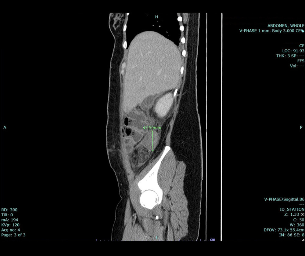 Previous computed tomography scan of the patient’s entire abdominal region (sagittal view). Identification of fluid accumulation with concomitant air bubble formation from the lower uterine segment, raising concerns of potential uterine dehiscence at her prior cesarean section scar site. Remarkable abscess formation, characterized by dimensions of 6.5×1.4×3.6 cm and 2.1×3.4×2.3 cm, noted in the subhepatic region and the right paracolic gutter, measuring 4.6×2.9×15.2 cm and 4.7×4.5×5.6 cm, respectively.