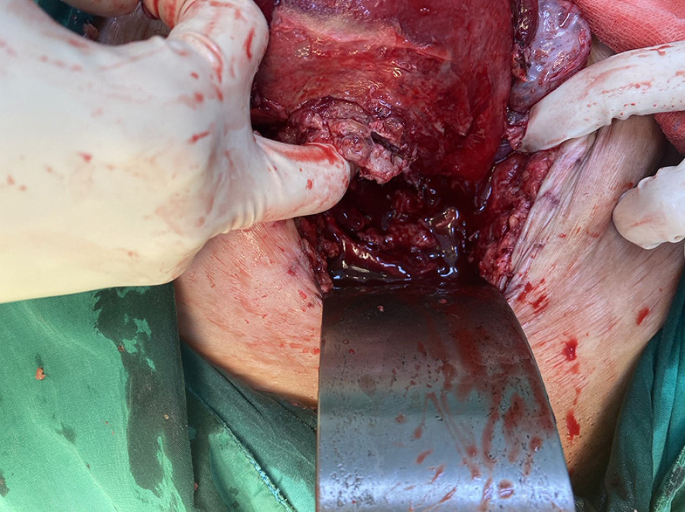 Intraoperative image depicts a total lower uterine dehiscence spanning 10 cm. This dehiscence is characterized by fragility, indicating weakness in the tissue structure, and the presence of necrotic tissue, suggesting tissue death, both observed at the lower uterine segment and surgical margins.