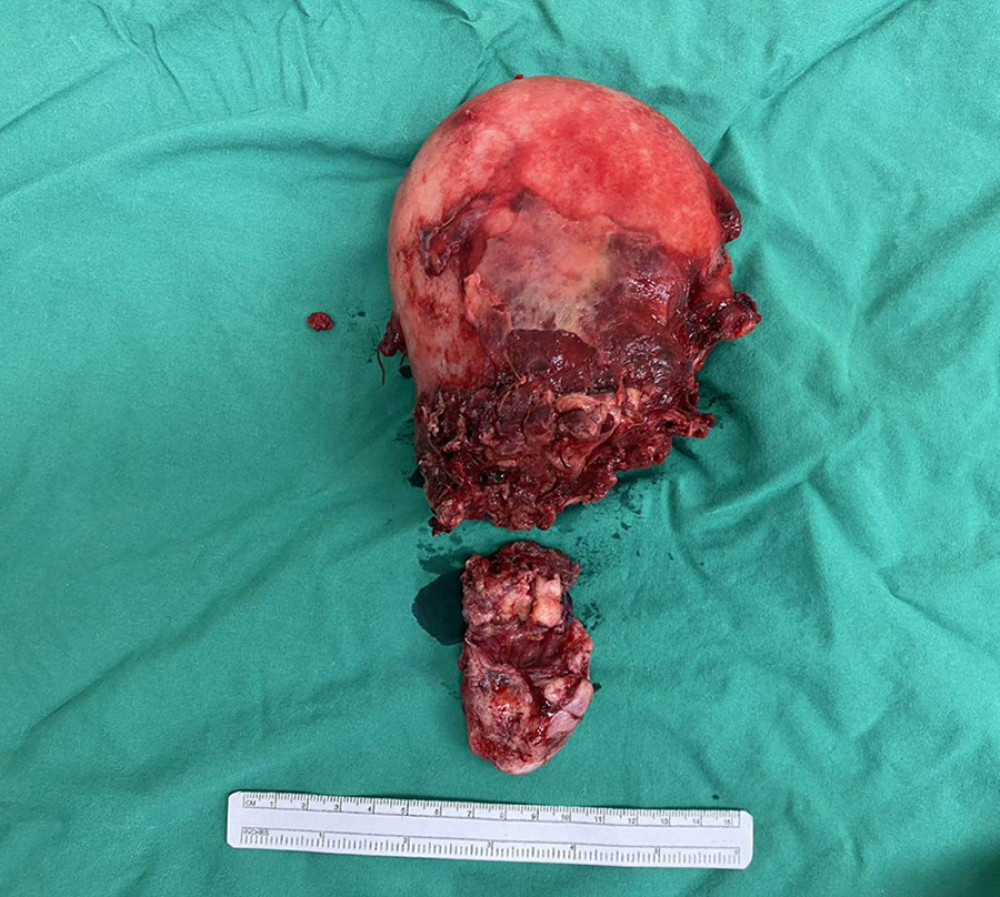The specimen presented is the body of the uterus with the cervix, specifically showing the posterior surface. It is notable that the uterus is separated into 2 pieces due to the presence of fragile, necrotic tissue at the lower uterine segment. This separation is likely a result of the weakened tissue integrity caused by the necrotic tissue.