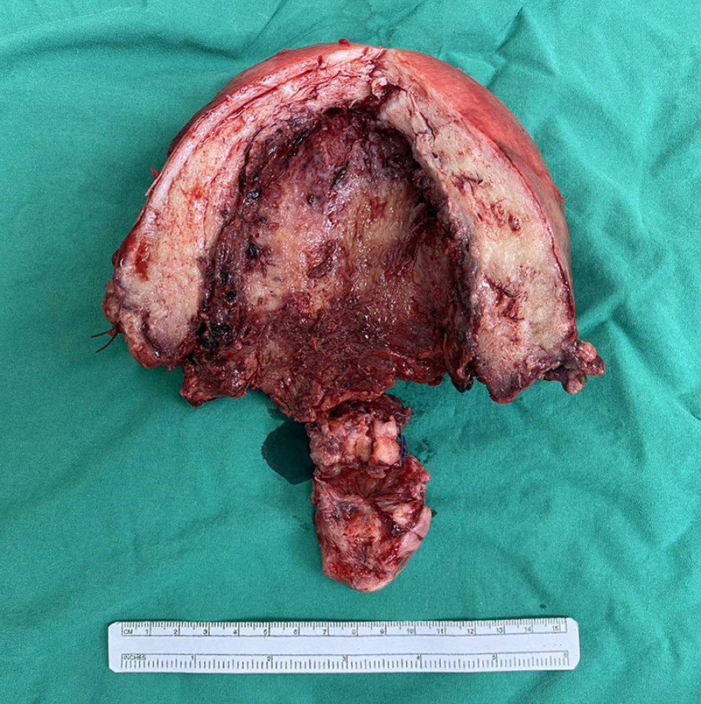 The specimen presented shows the separation of the uterus into 2 parts, specifically caused by necrotic tissue located at the lower uterine segment. This separation into 2 parts is a consequence of the weakened tissue integrity resulting from the presence of necrotic tissue, which can lead to structural instability and potentially serious complications.