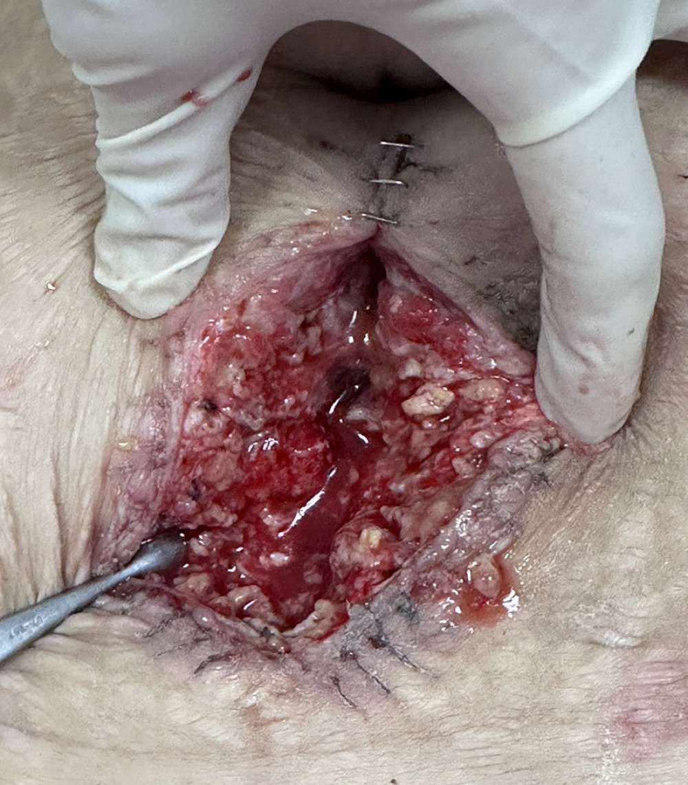 After the removal of the Jackson drain, a disruption or separation of the abdominal wound was observed.