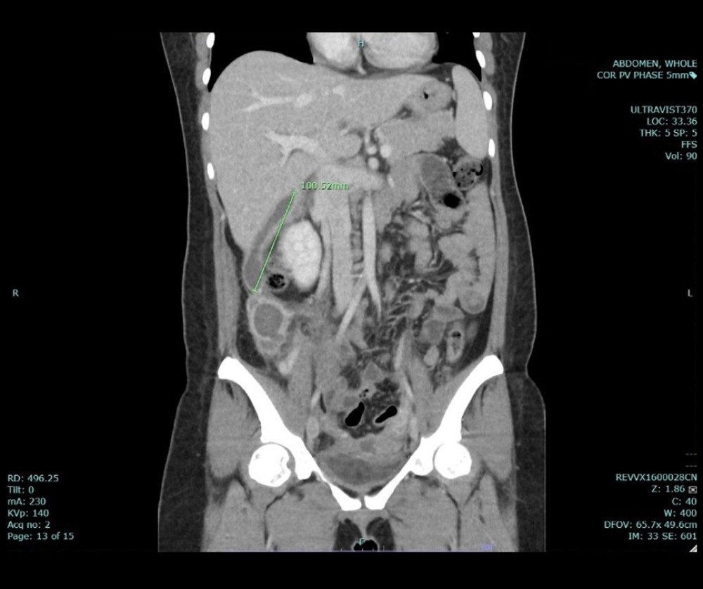 Postoperative computed tomography scan of the patient’s entire abdominal region (coronal view). A follow-up computed tomography scan revealed the continued presence of pus collection in the subhepatic region and the right paracolic gutter, although it appeared to be smaller in size than the previous scan.