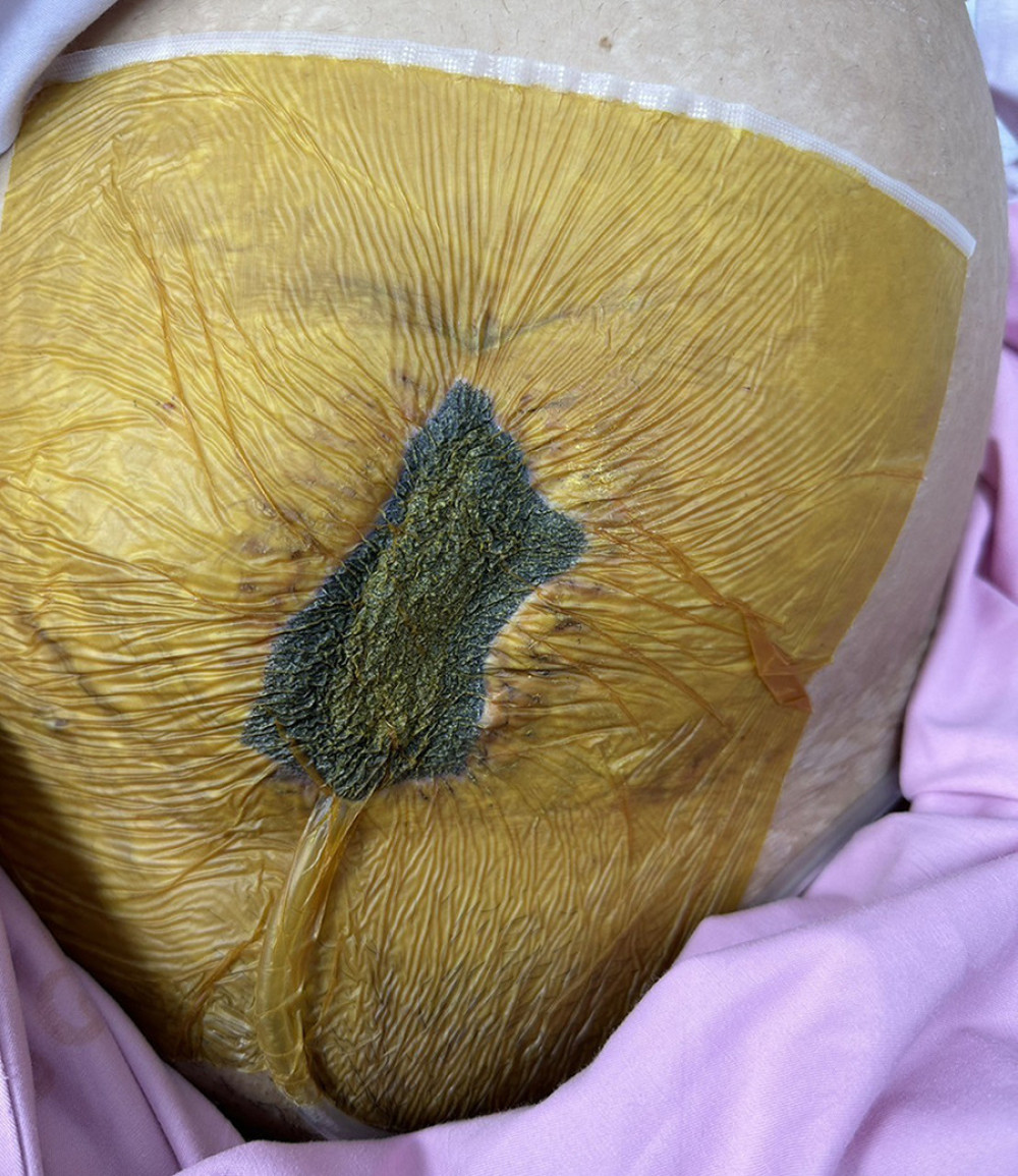The plastic surgeon recommended the use of vacuum dressings with continuous drainage to manage the disrupted wound.