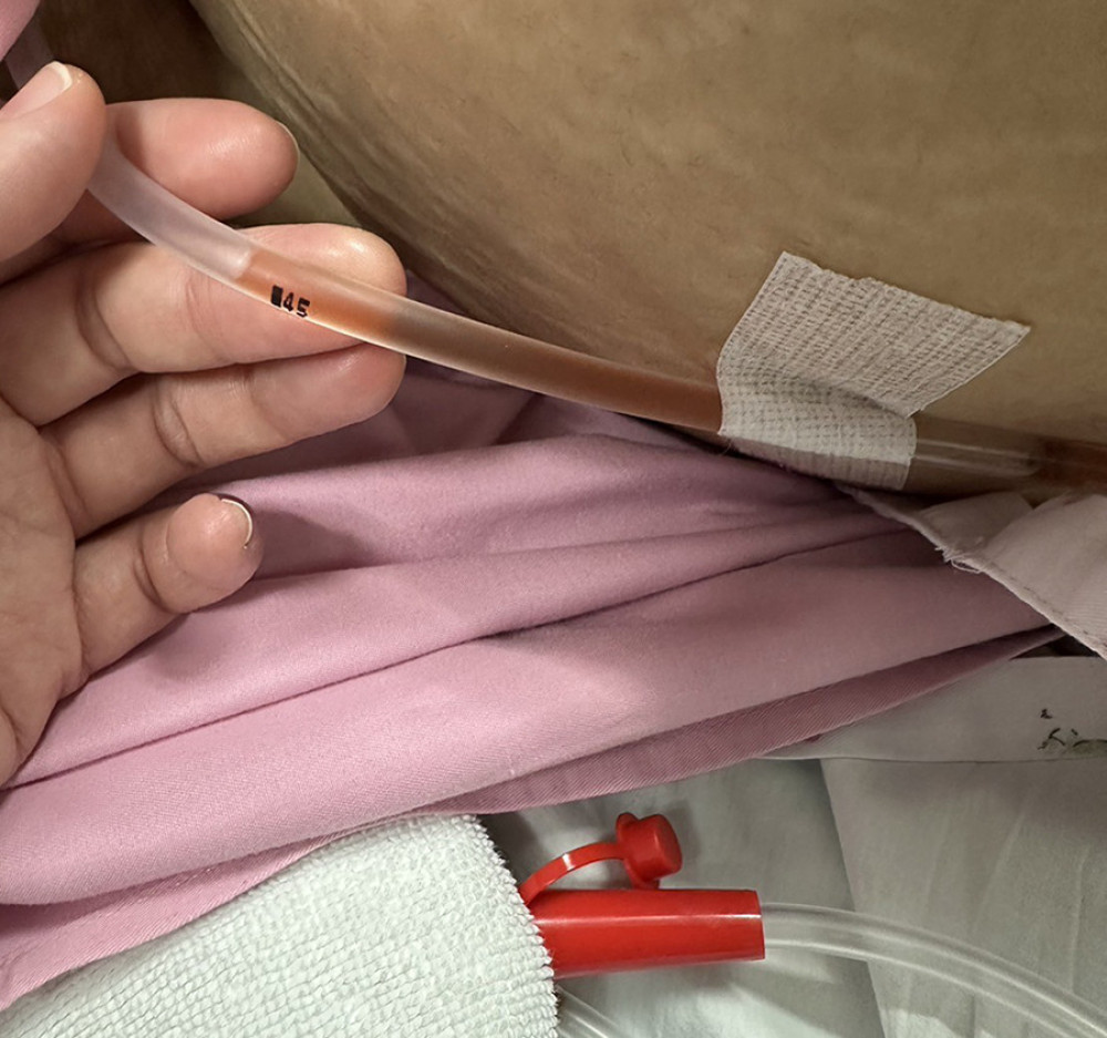 An interventional radiologist was engaged to perform percutaneous drainage under ultrasound guidance.