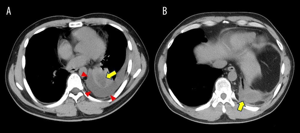 Chest computed tomography (CT) images upon hospital arrival. Pre-admission chest CT showing left pleural effusion (arrow head) and a lung abscess (arrow) within the atelectasis of the left lower lobe (A). CT upon recurrence showing a mass at the site of the previous empyema cavity, along with pleural thickening and a low-attenuation area inside (B).