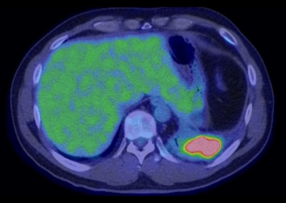 Positron emission tomography-CT prior to CT-guided needle biopsy. Positron emission tomography-CT revealing enhanced 18F-fluorodeoxyglucose uptake in the mass, with a maximal standardized uptake value of 18.61.