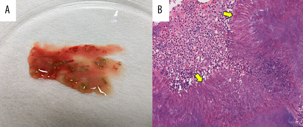 The specimen obtained through the second CT-guided biopsy. During the second CT-guided biopsy, viscous purulent pleural effusion was aspirated, and greenish-yellow sulfur granules were confirmed macroscopically (A). Microphotography of the sulfur granules, showing actinomycotic granules (arrow) surrounded by inflammatory cell infiltration (B) (hematoxylin and eosin stain, magnification ×20).