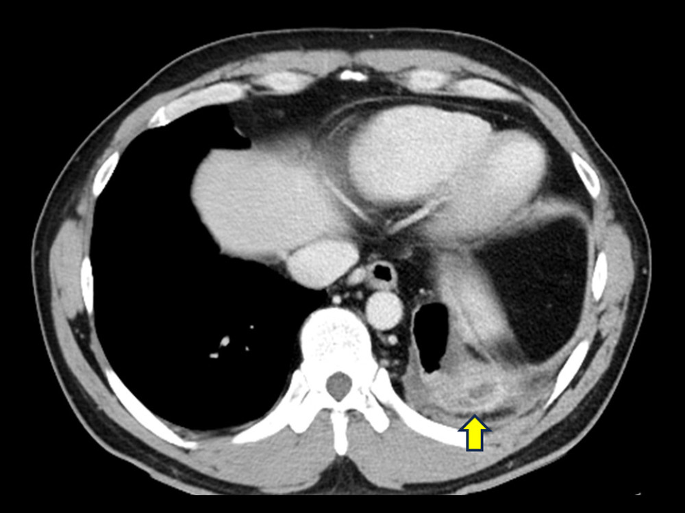 Contrast-enhanced CT prior to the surgical procedure. Contrast-enhanced CT showing a small area of low attenuation inside the enhanced thickened pleura (arrow). The empyema cavity exhibited slight reduction compared with the plain chest CT obtained prior to the initiation of antibiotic therapy.