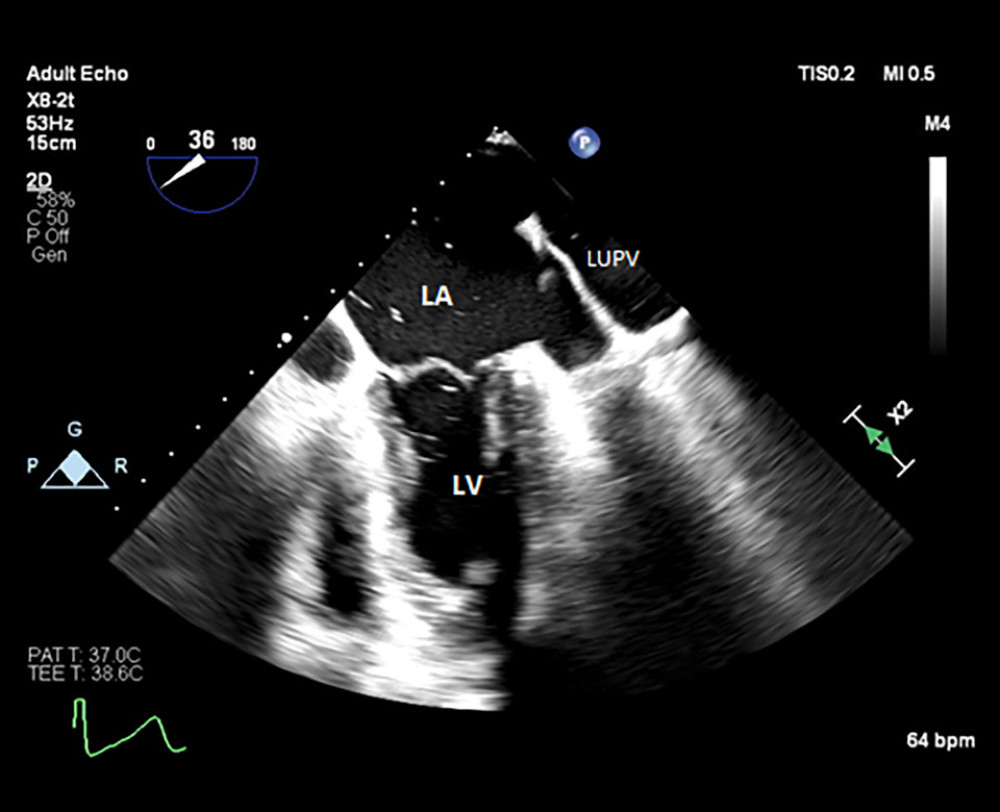 Mid-esophageal view of the left atrium and left ventricle, with air bubbles seen emerging from the left upper pulmonary vein. LA – left atrium; LV – left ventricle; LUPV – left upper pulmonary vein.