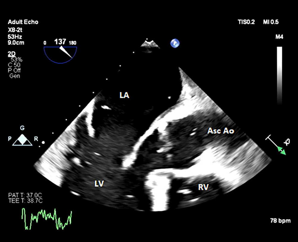 Mid-esophageal long axis view in diastole showing air bubbles within the LA, LV, RV, sinus of Valsalva and ascending aorta. LA – left atrium; LV – left ventricle; RV – right ventricle; Asc Ao – ascending aorta.
