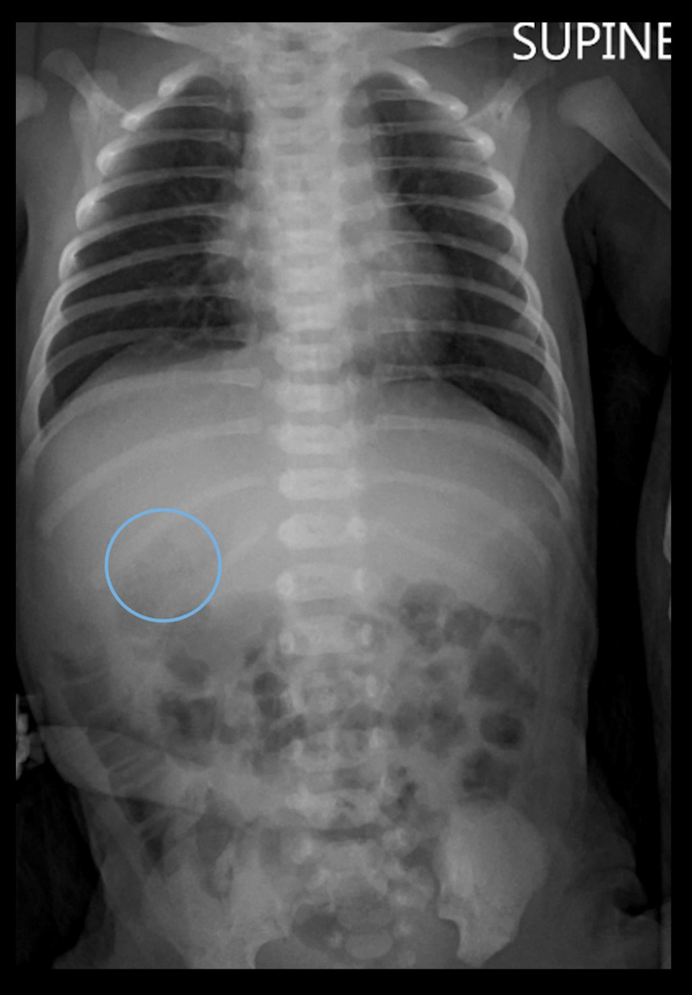 Chest and abdominal radiograph showing gastric bubble in the right hypochondrium (blue circle). There are no dilated bowel loops.
