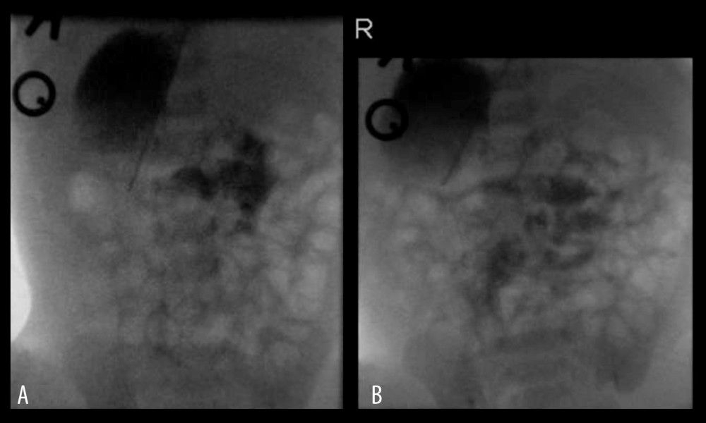 (A, B) Dextrogastria with position of duodenojejunal flexure not elucidated.