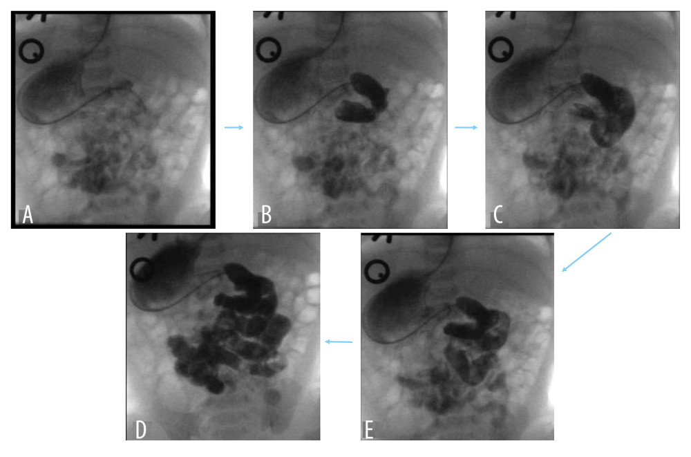 (A–E) Sequential grab images from selective duodenography revealed the duodenal loop and the duodenojejunal flexure on the left side of the spine, with the latter below the duodenal bulb level.