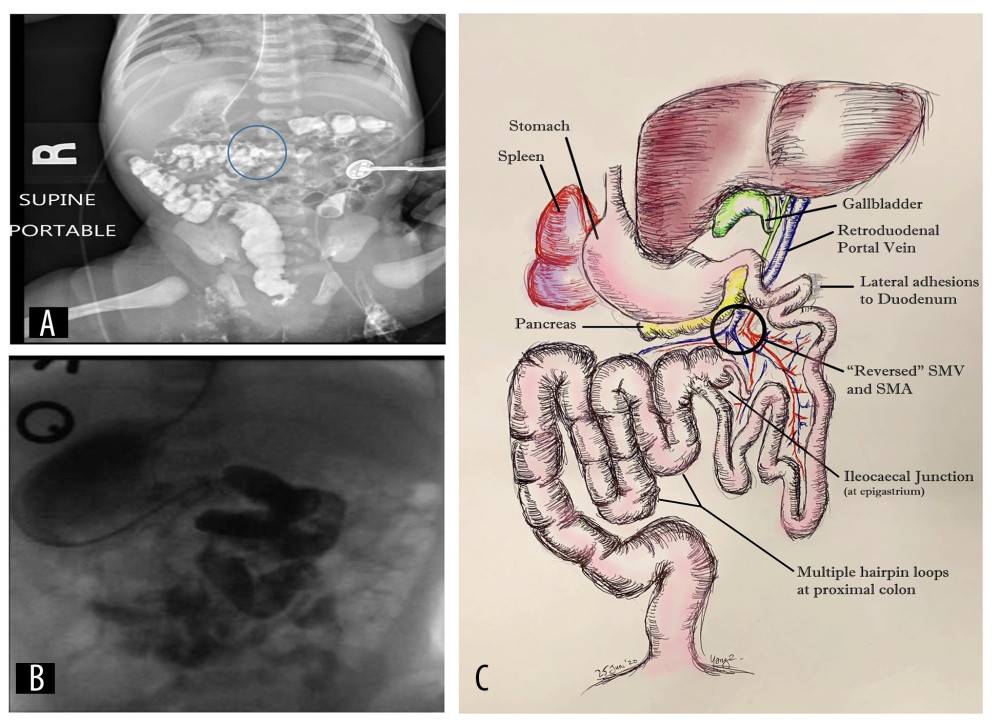 Additional follow-through radiograph (A) showed the cecum in the epigastric region (blue circle) and right-sided colonic loops. Together with a DJ flexure left of midline (B), imaging features suggested a narrow mesenteric pedicle with attendant risk of midgut volvulus. Pictorial diagram (C) shows congenital anatomic abnormalities found intra-operatively.