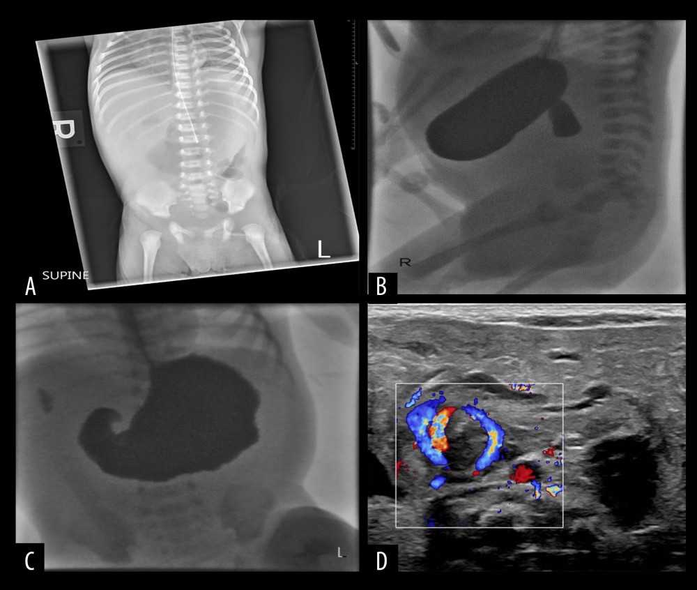 (A–D) Abdominal radiograph and upper-GI contrast study suggest a high-grade obstruction at the level of the proximal duodenum. US reveals reversal of superior mesenteric vessels.