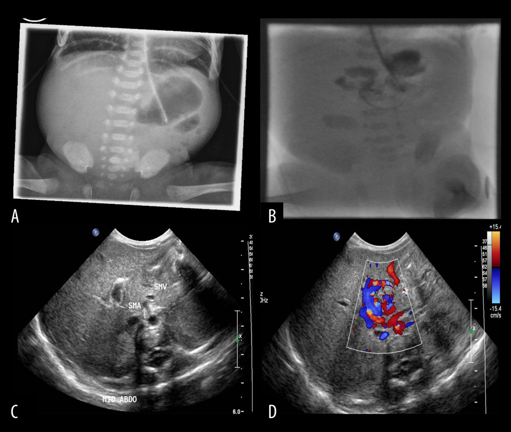 (A-D) Abdominal radiograph and upper-GI contrast study suggest high-grade obstruction at level of proximal duodenum. US findings suspicious for malrotation.