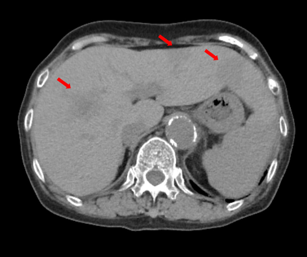 A plain CT scan shows some low-density areas in the liver (red arrows).
