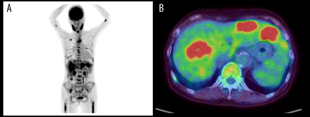 (A) FDG PET image shows multiple uptake lesions in the liver and bone marrow, and focal uptake of the right lung nodule. (B) FDG PET/CT shows multiple uptake lesions in the liver.