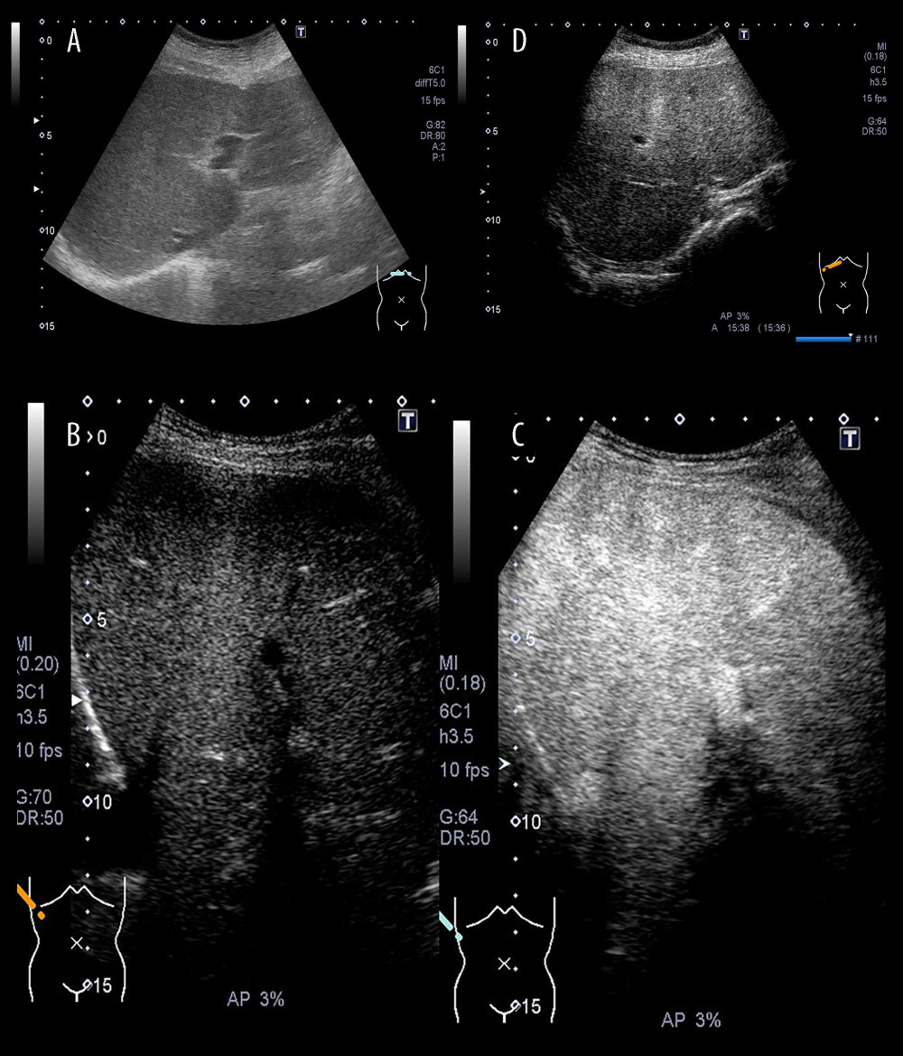 CEUS findings. (A) No nodular lesion is observed in B mode images of both liver lobes. (B) Before administration of Sonazoid. (C) Systemic enhancement is seen in the early vascular phase. (D) A defect is not observed at any locations in the post-vascular phase.