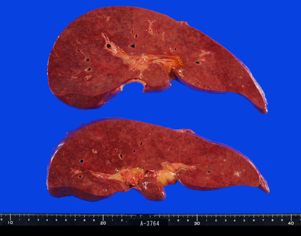 Macroscopic findings of the liver show ill-defined, pale white changes in both liver lobes.