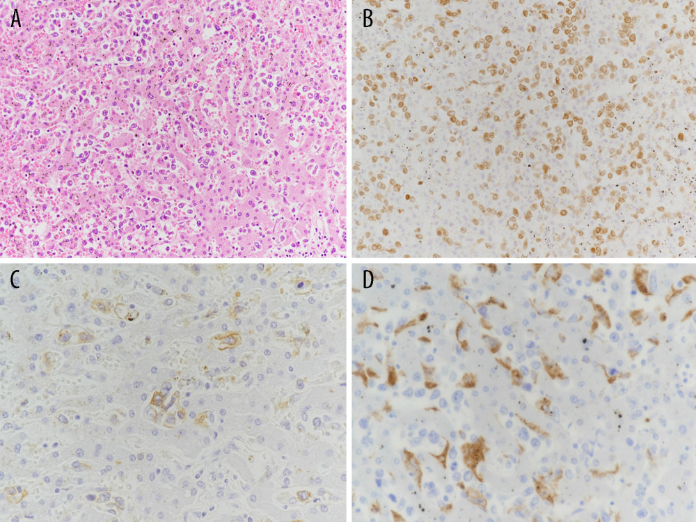 Histological findings of the liver show: (A) Diffuse infiltration of large neoplastic lymphoid cells in liver sinusoids. (HE staining); (B) The neoplastic cells positive for CD79a; (C) The neoplastic cells positive for CD20; (D) A number of CD68-positive Kupffer cells co-existent with the neoplastic cells in liver sinusoids.