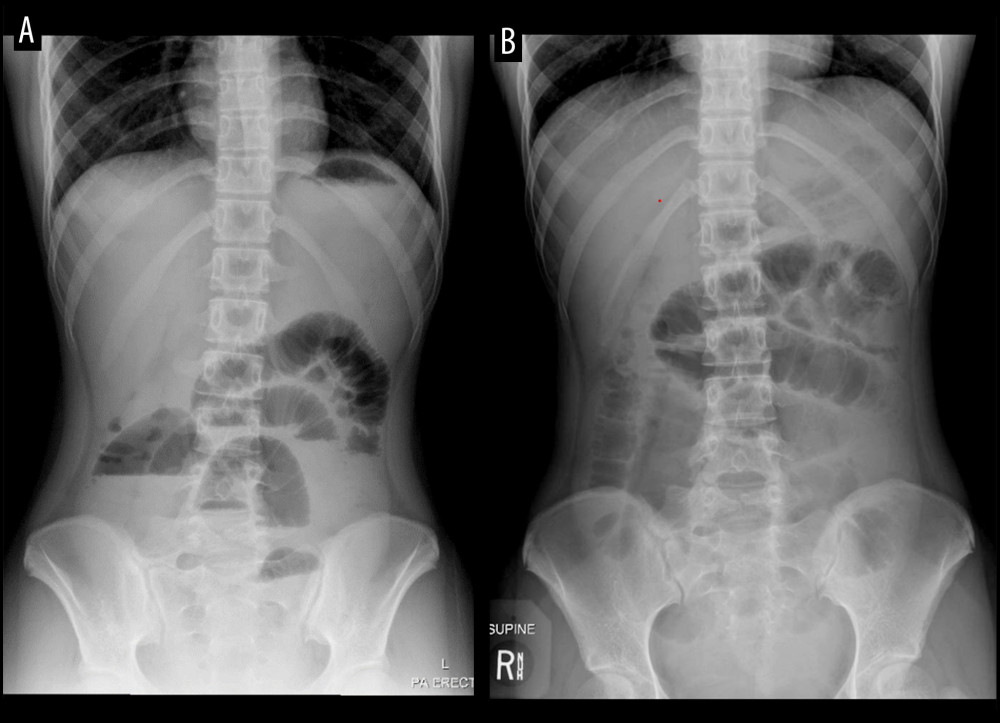 Erect (A) and supine (B) position abdominal X-rays demonstrating multiple dilated small bowel loops and air-fluid levels.