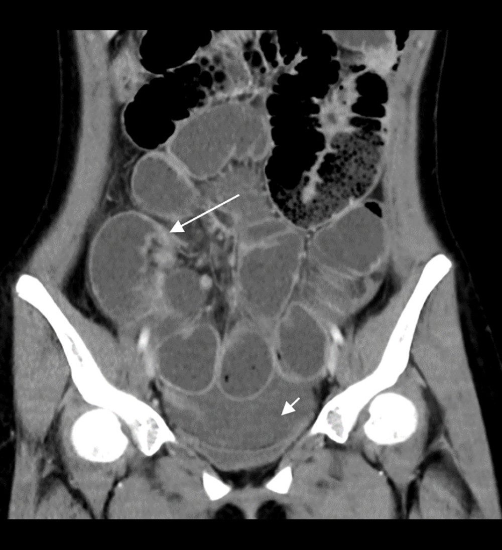 Computed tomography (CT) coronal section of the abdomen and pelvis demonstrating multiple fluid-filled bowel loops with a transition point at the right iliac fossa (long arrow) and ascites in the pelvis (short arrow).