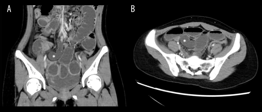 Computed tomography (CT) of the abdomen and pelvis showing the blind-ending “C” looped of bowel (asterix) on coronal (A) and axial (B) sections.