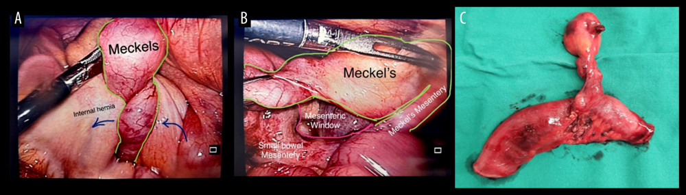 Intraoperative images demonstrating the internal hernia (A) and the mesenteric window created by the Meckel’s diverticulum mesentery and small bowel mesentery (B). Post-resection image of the Meckel’s diverticulum (C).