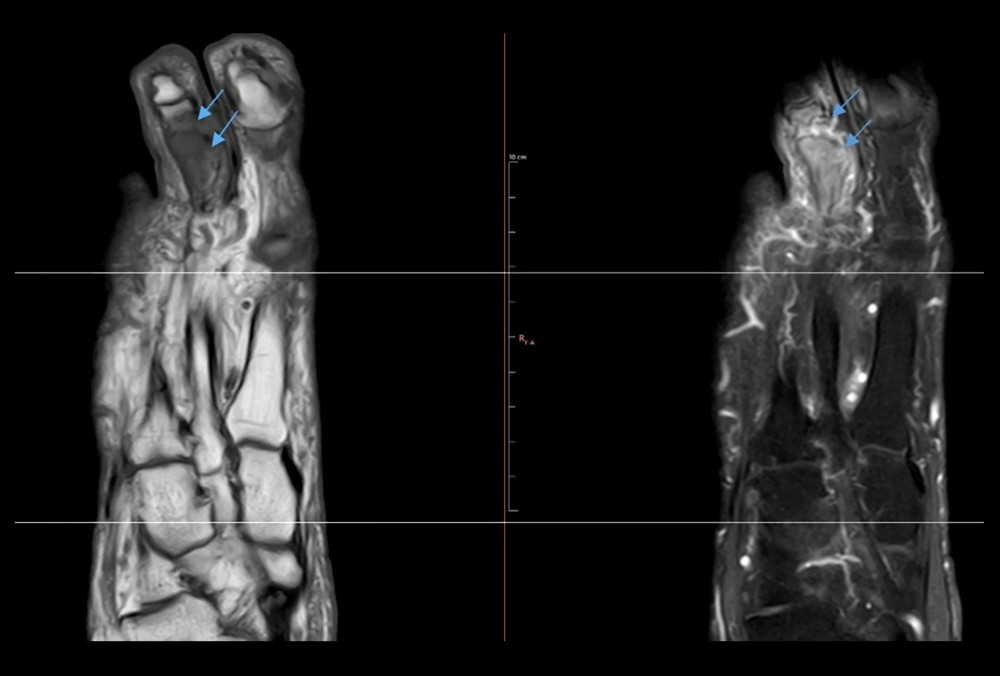 MRI scan of the right foot. Contrast-enhancing osteolysis of the proximal and the middle phalanx of the second right toe (blue arrows), with associated pathological contrast enhancement of the bone marrow and diffuse surrounding soft tissue edema. MRI – magnetic resonance imaging.