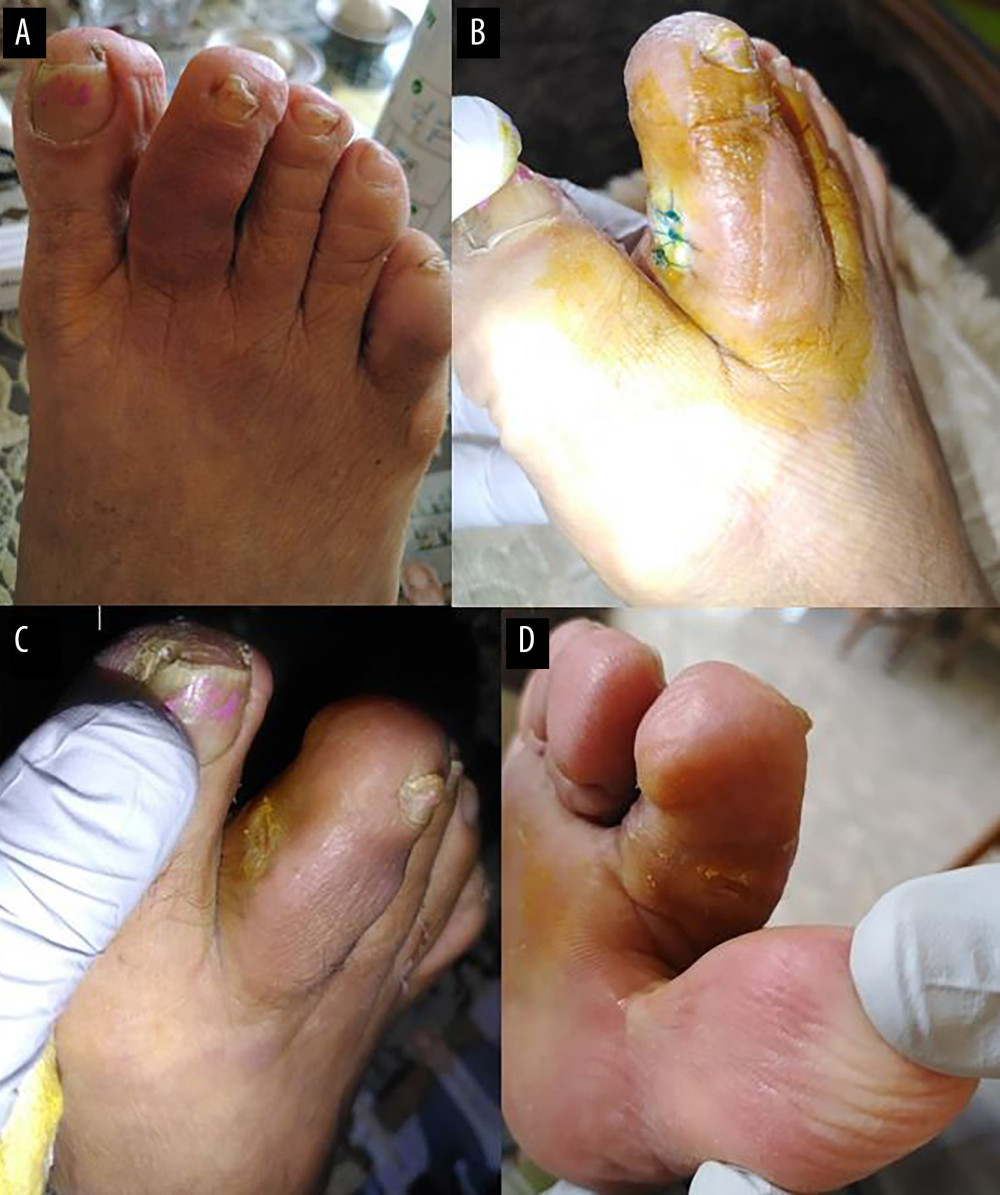 Progression of wound healing in the second right toe: (A) ‘Sausage’ toe deformity; (B) DFU in the second right toe at presentation; (C) the affected toe 4 weeks after the beginning of antimicrobial therapy; (D) the affected toe at the end of antimicrobial therapy. DFU – diabetic foot ulcer.