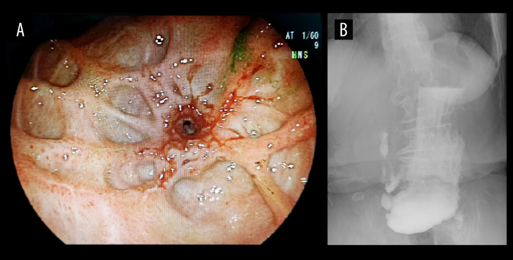Gastroscopy and upper gastrointestinal radiography. (A) Gastric antrum mucosa showed more scarring, pale mucosa, rough and uneven surface, prepyloric cicatricial stenosis 6–7 mm in diameter, and the endoscope could not pass through. (B) Upper gastrointestinal radiography after drinking compound meglumine diatrizoate showed gastric filling was fishhook type, gastric mucosal folds were thickened and disordered, tension was reduced, peristalsis was slow, pyloric canal filling was poor, and contrast agent passed slowly.