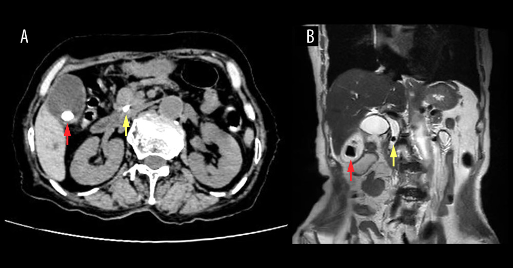 (A) Computed tomography and (B) magnetic resonance cholangiopancreatography examinations. Red arrow, gallbladder stone; yellow arrow, calculi of the common bile duct.