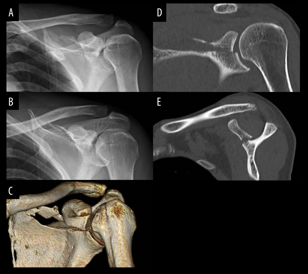 Preoperative radiography revealing fractures of the left distal clavicle and coracoid process (A, B). Computed tomography of the left scapula demonstrates that the fracture line extends from the coracoid process base to the glenoid fossa (C–E).