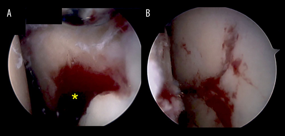 Intra-articular arthroscopic findings. Before reduction of the coracoid process fracture, a displacement of the glenoid articular surface (yellow asterisk) was observed (A). After reduction, fracture displacement improved (B).
