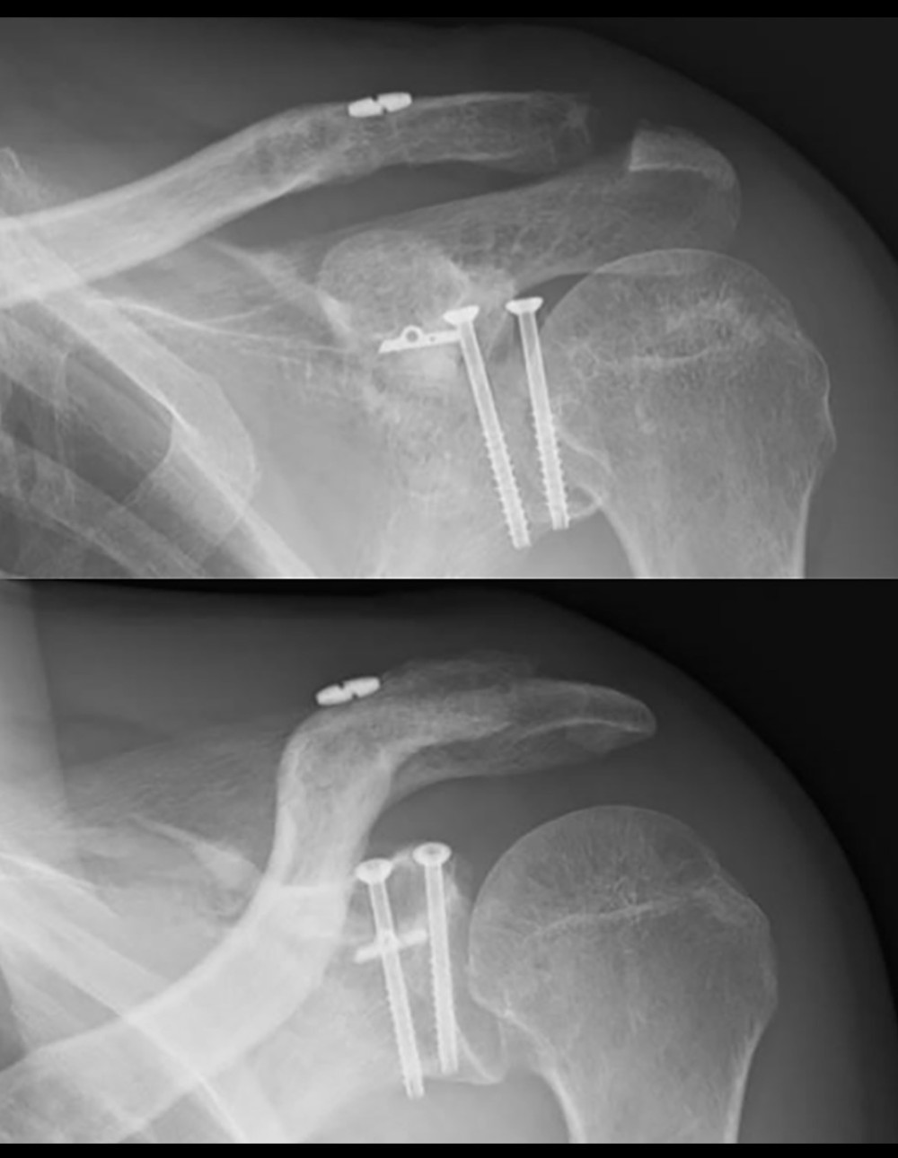 Radiographs immediately after plate removal.