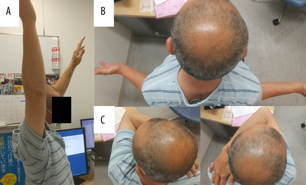 Clinical photographs of the shoulder range of motion during anterior elevation (A), external rotation (B), and horizontal adduction (C) 1 year postoperatively.