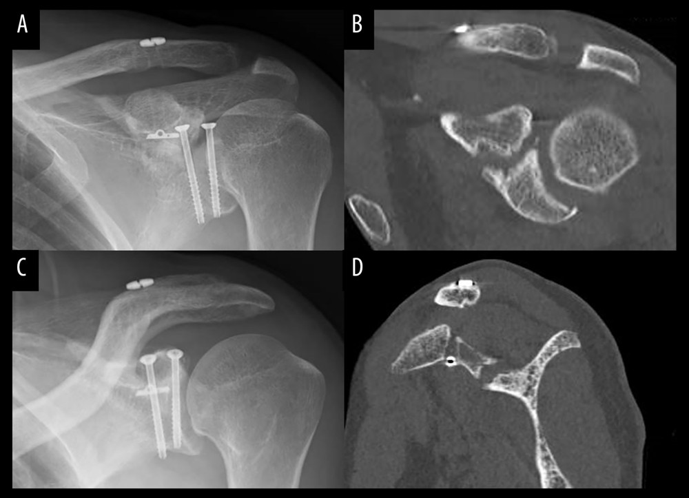 Plain radiographs and computed tomography (CT) 1 year postoperatively. Radiographs confirm bone union of the distal clavicle fracture (A, B). Coronal (C) and sagittal (D) views of CT demonstrate a nonunion of coracoid process fracture.