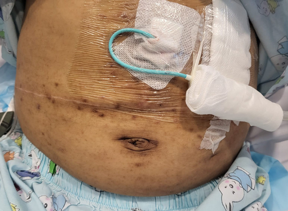 Multiple papules over abdomen of a 13-year-old girl during her early post-transplant period.