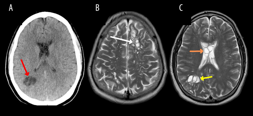 (A) CT head showed a cluster adjacent to the occipital horn of the right lateral ventricle, which measured maximally 2.6×2.3 cm across (red arrow). (B) MRI brain showed multilocular cystic lesions within the frontal and parietal cortices (white arrow). (C) Cystic lesions seen in the corpus callosum (orange arrow) and occipital lobe (yellow arrow).