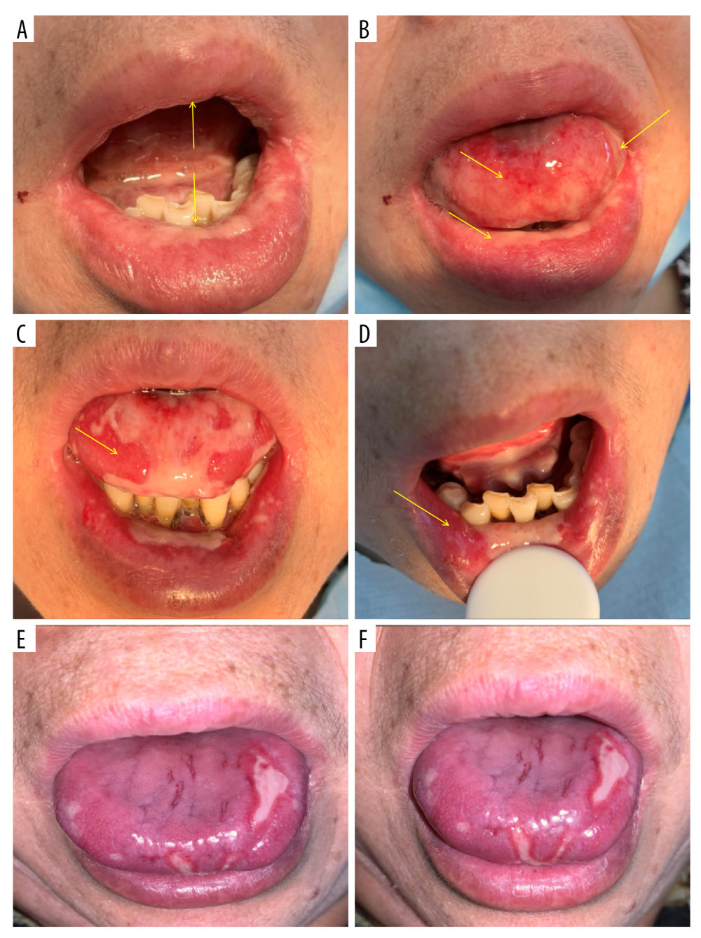 Images of the patient at the initial visit and after treatment. Day 1. (A) Initial visit, moderate limitation in mouth opening, restricted tongue movement; (B) Extensive erosion of the tongue and oral mucosa; Day 2. (C) The next day, mild limitation in mouth opening, improved tongue movement compared to before, partial healing of the dorsal tongue and mucosa; (D) Increased yellow pseudomembrane on the mucosal surface; Day 3. (E) Third day of medication, no limitation in mouth opening, free tongue movement, small portion of mucosa not healed; (F) Slight reddening at the edges of the pseudomembrane.