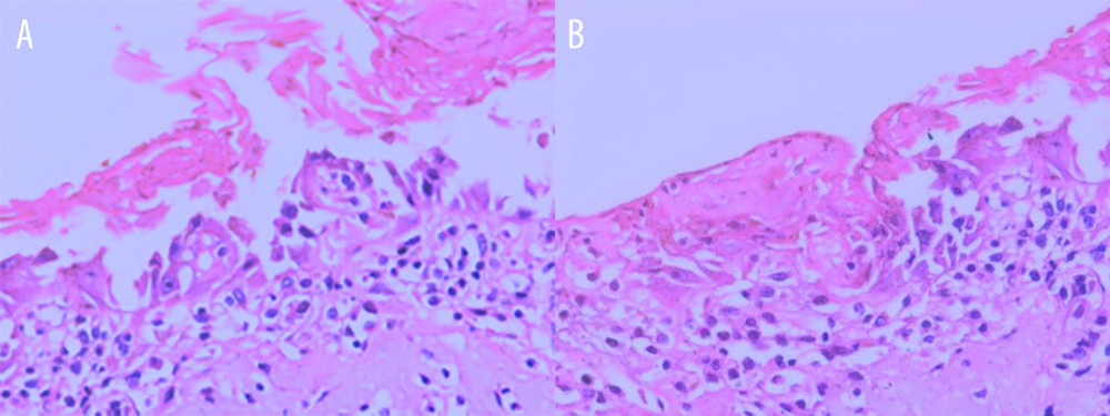 (A, B) Pathological images of the mucosa and submucosal glandular tissue at the erosion site on the lower left lip.