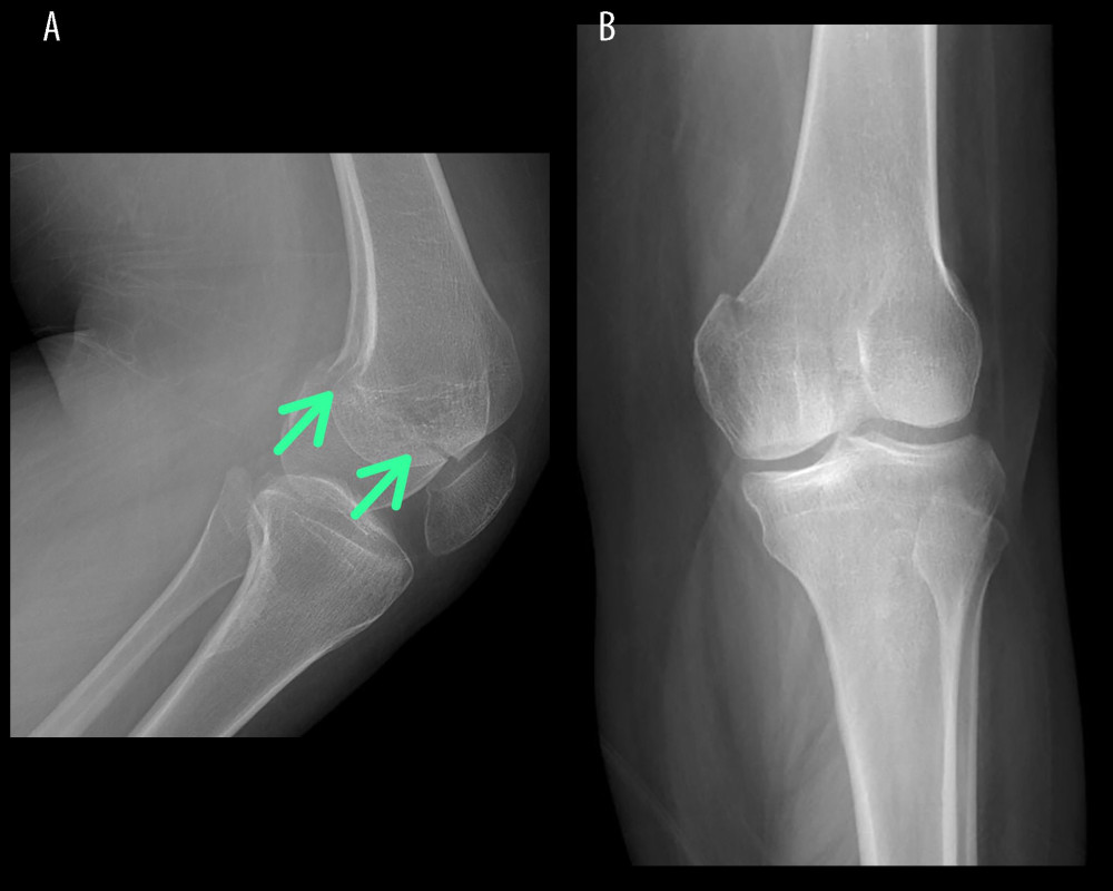 (A, B) Anteroposterior and lateral radiographs of the left knee. Displaced medial Hoffa fracture with an oblique fracture line. Green arrows show the direction of the fracture line.