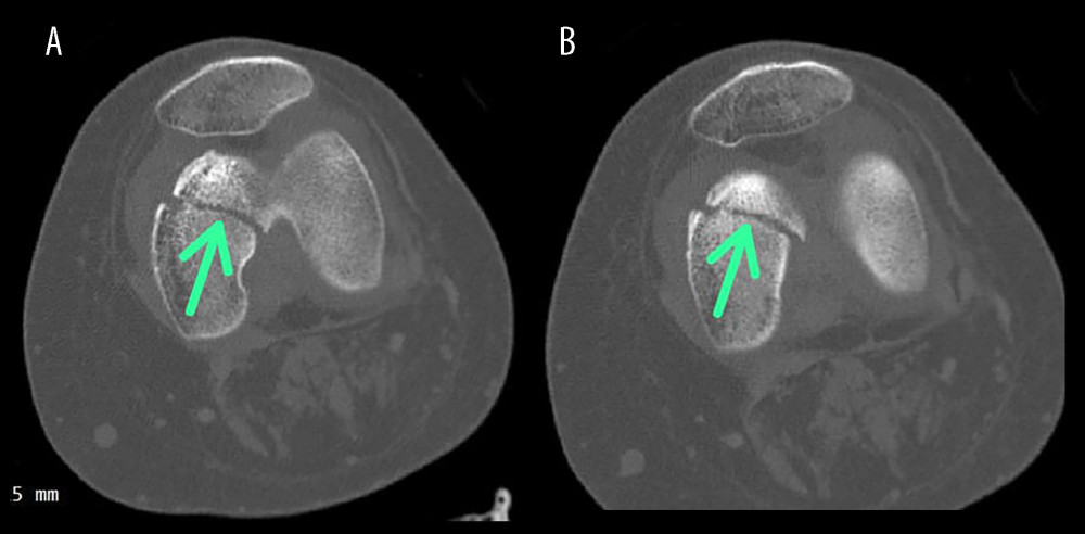 Axial left distal femoral condyle CT scan. (A) Computed tomography scan of the left knee shows coronally oriented fracture through the medial femoral condyle with an oblique fracture line through the medial femoral condyle. (B) Green arrows show the oblique fracture line with displacement of the fracture fragment.