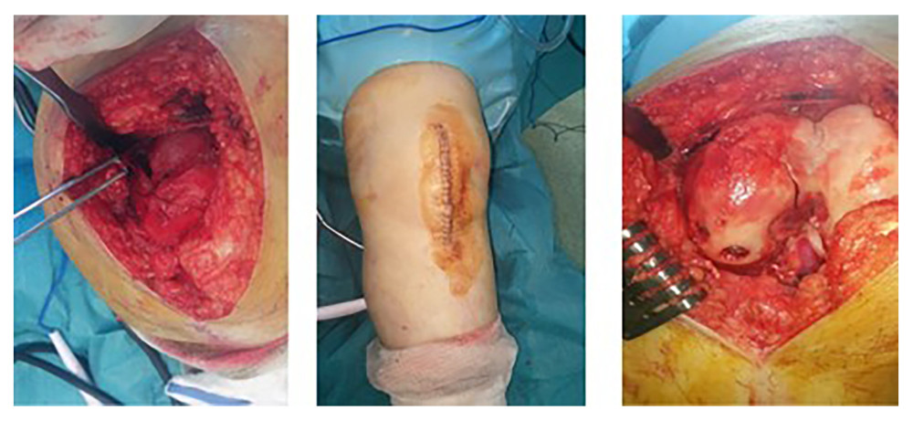 Medial parapatellar approach via midline incision with intraoperative real images.