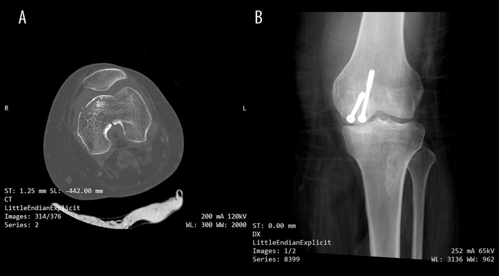 X-ray images of the left knee. (A) Anteroposterior and (B) lateral views, at 2 years follow-up showing complete healing of the fracture without any hardware-related complications.