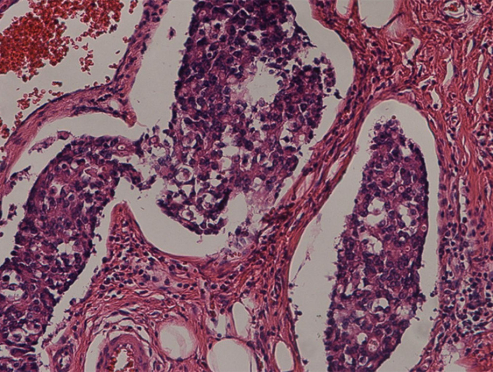 Pathological specimen of gastric cancer, characterized by poorly differentiated adenocarcinoma with a component of signet ring cell carcinoma (approximately 10%). Microscopic magnification 20×10, using a Nikon ECLIPSE 80i microscope.