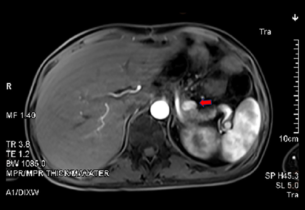 Dynamic MRI scan of the pancreas. As indicated by the red arrow, there is a highlighted nodular lesion situated in the pancreatic body, measuring approximately 1.5×1.0 cm. This lesion displays well-defined margins, conspicuous enhancement during the arterial phase, and mild dilation of the pancreatic common bile duct.